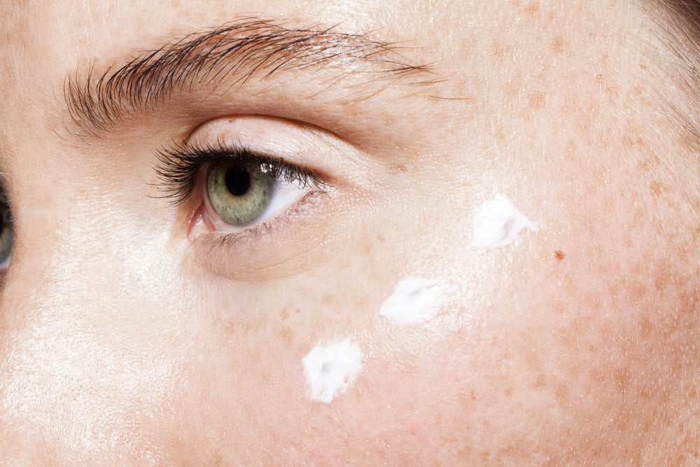 What Causes Dark Circles Around the Eyes - How Do You Get Rid of Them?